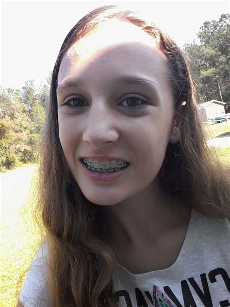 brace girl leak|r/bracesgirl5